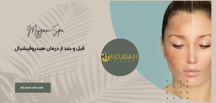 مراقبت پوست 3 قبل و بعد از درمان-هیدروفیشیال پوست