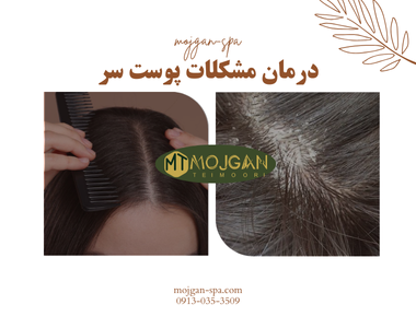 درمان مشکلات پوست سر-اسکراب اسکالپ