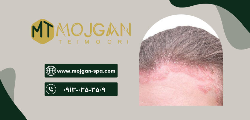 علائم قارچ پوست - قارچ پوست سر