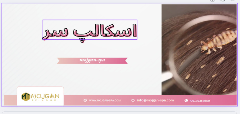 علائم شپش سر - شپش سر