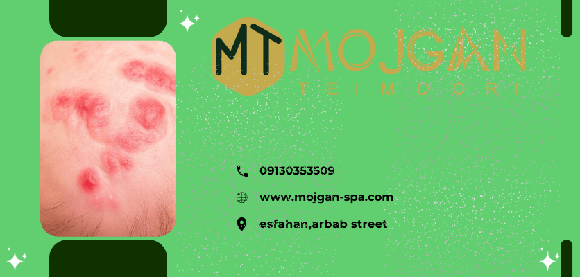 پوست سر حساس با التهاب و قرمزی-قرمزی کف سر